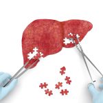 Results from the NASH-FX Study Underscore the Importance of Completing the NASH-CX Clinical Trial for Patients with NASH Cirrhosis